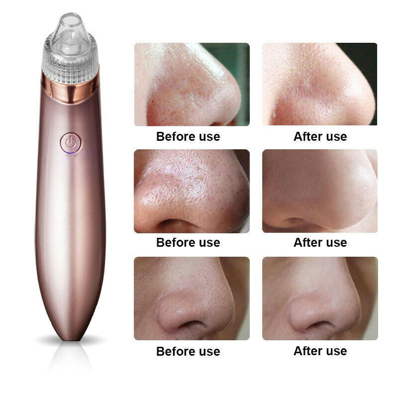 Electric Pore Vacuum – Blackhead & Acne Remover
