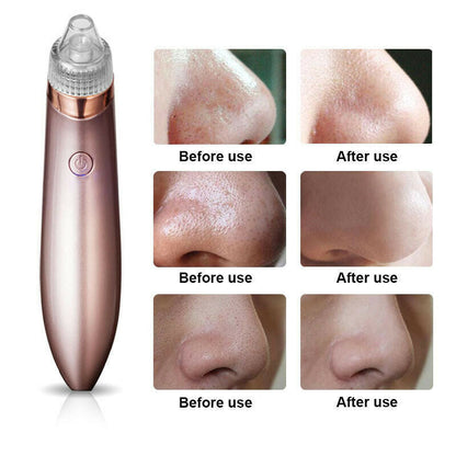 Electric Pore Vacuum – Blackhead & Acne Remover